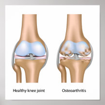 Osteoarthritis von Kniegelenk Plakat