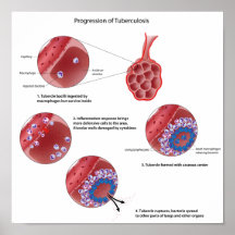 Weiterentwicklung von Tuberkulose der atmungsorgan