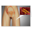 Suche nach arterie postkarten Blut