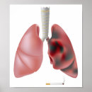 Suche nach lungenkrebs poster Krankheit