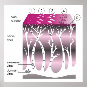 Abbildung des Fortschreitens der Gürtelrose auf de Poster