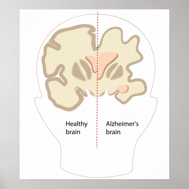 Alzheimer-Syndrom Poster (Vorne)