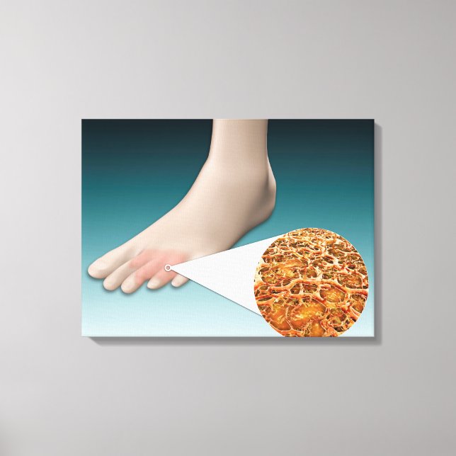 Anatomie des Foot Fungus mit mikroskopischer Nah-u Leinwanddruck (Vorderseite)