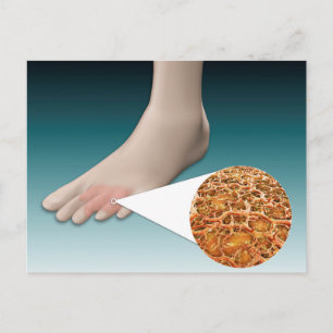 Anatomie des Foot Fungus mit mikroskopischer Nah-u Postkarte