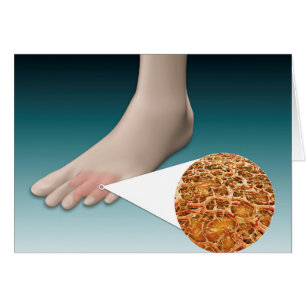 Anatomie des Fuß-Pilzes mit mikroskopischer
