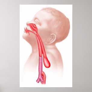 Anatomie einer Tracheesophagealfistula Poster