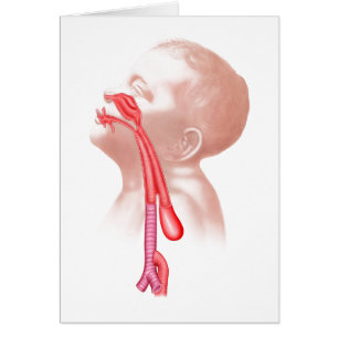 Anatomie einer Tracheoesophageal Fistel
