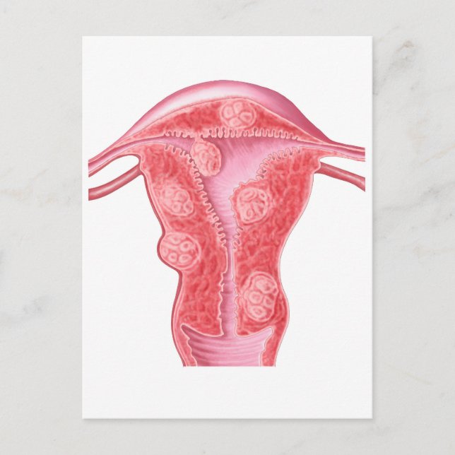 Anatomie fibroider Tumoren bei weiblichen Uterusze Postkarte (Vorderseite)