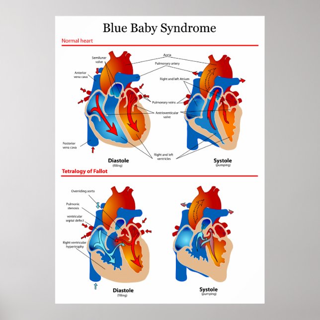 Anatomisches Herzdiagramm des Blue-Baby-Syndroms Poster (Vorne)