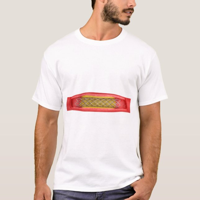 Angioplastie mit Stentplatzierung T-Shirt (Vorderseite)