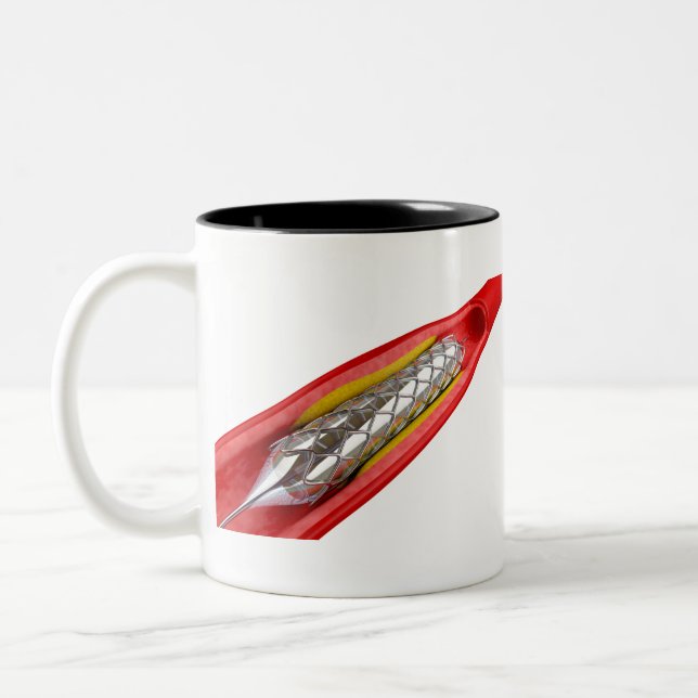 Angioplastik Zweifarbige Tasse (Links)