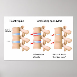 Ankylosierende Spondylitis Poster