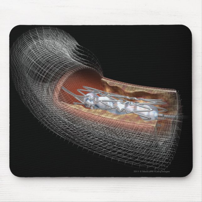 Ansicht eines angioplaty Ballons in einer Arterie Mousepad (Vorne)