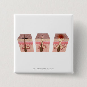 Ansicht von, was Akne verursacht Button