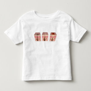 Ansicht von, was Akne verursacht Kleinkind T-shirt
