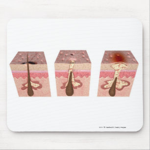 Ansicht von, was Akne verursacht Mousepad