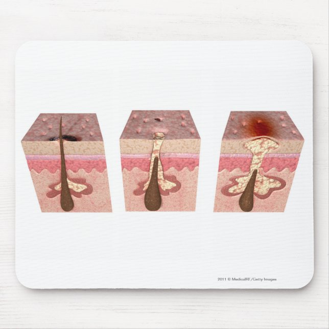 Ansicht von, was Akne verursacht Mousepad (Vorne)