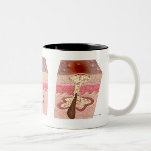 Ansicht von, was Akne verursacht Zweifarbige Tasse