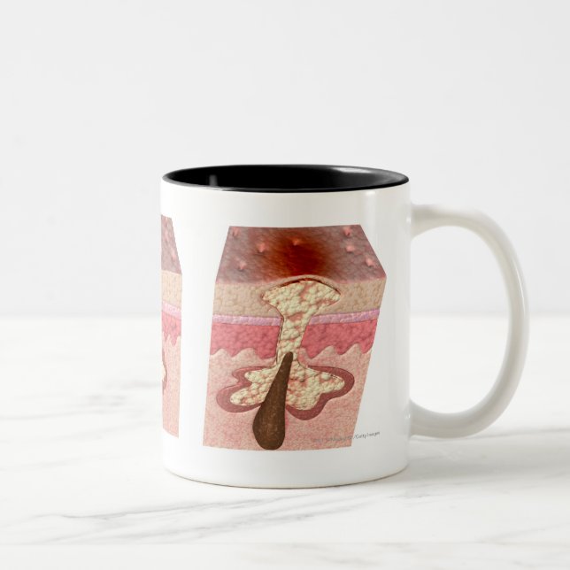 Ansicht von, was Akne verursacht Zweifarbige Tasse (Rechts)