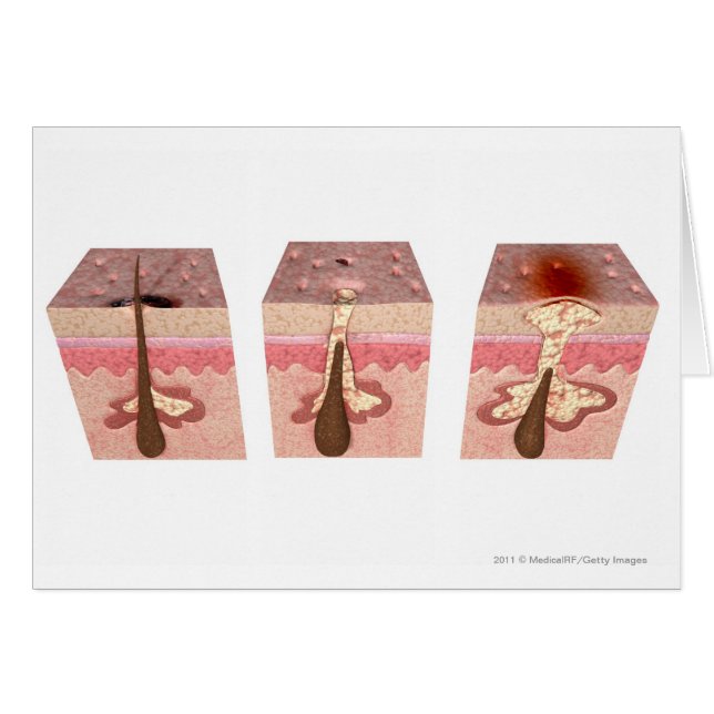 Ansicht, was Akne verursacht (Vorderseite (Horizontal))