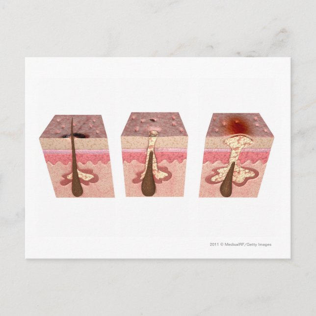 Ansicht, was Akne verursacht Postkarte (Vorderseite)