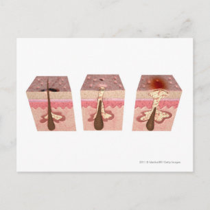 Ansicht, was Akne verursacht Postkarte