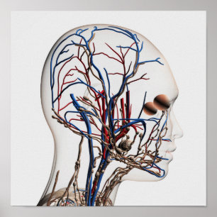 Ärztliche Veranschaulichung der Kopfschmerzen 1 Poster