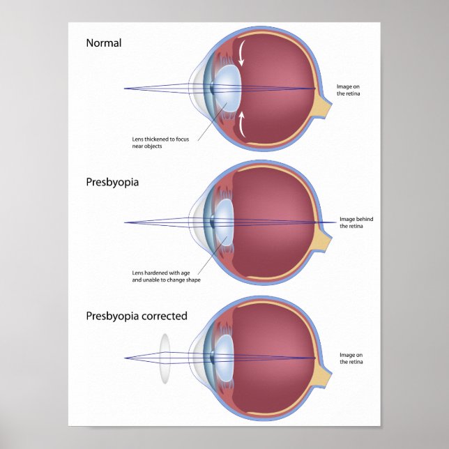 Augendefekt Presbyopia Poster (Vorne)