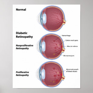 Augenerkrankung Diabetische Retinopathie Poster