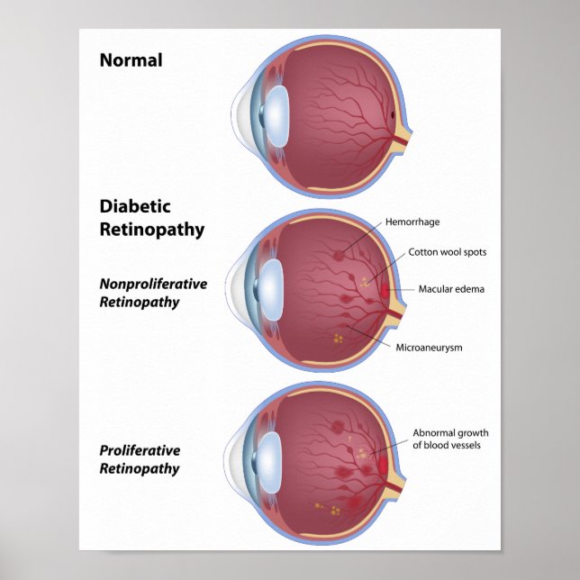 Augenerkrankung Diabetische Retinopathie Poster (Vorne)