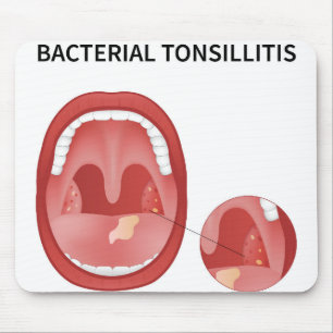 Bakterielle Tonsillitis Mousepad