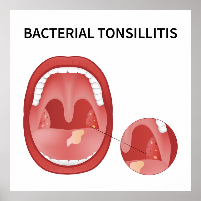 Bakterielle Tonsillitis Poster (Vorne)