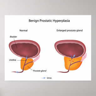 Benignes Prostatahyperplasie Poster