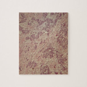 Brustkrebs unter dem Mikroskop Puzzle