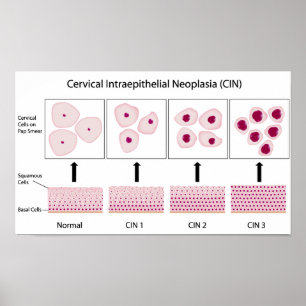 Bühnen der zervikalen Dysplasie und Pap-Abstrichte Poster