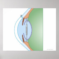 Cataract-Operation