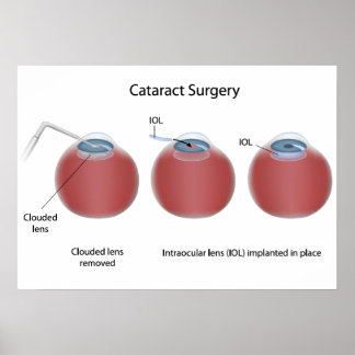 Cataract Operation Poster