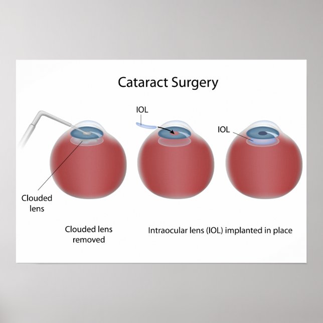 Cataract Operation Poster (Vorne)