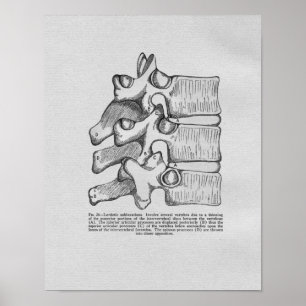 Chiropraktiksubluxations-Vintager Druck Poster