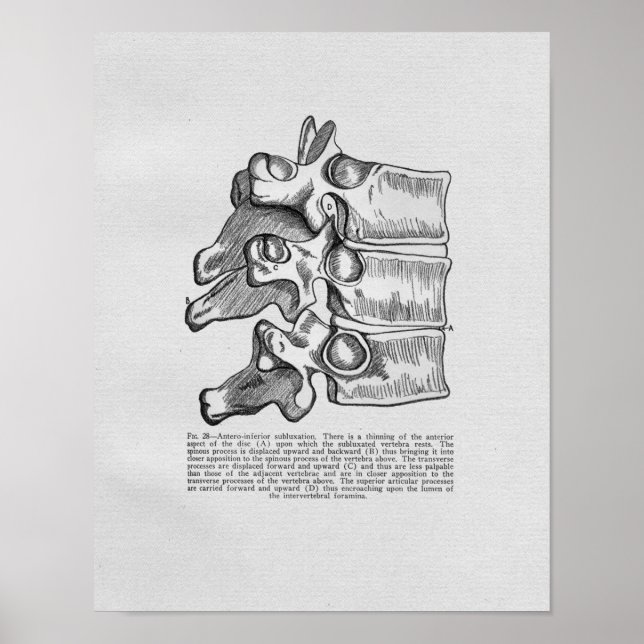 Chiropraktische vertebrale Subluxation Vintag Prin Poster (Vorne)