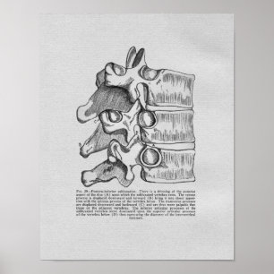 Chiropraktische vertebrale Subluxation Vintag Prin Poster