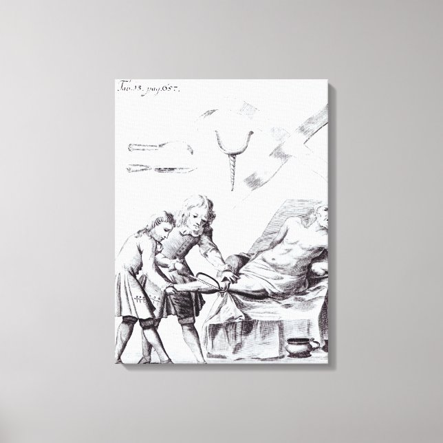 Chirurgische Operation zur Amputation eines Beins Leinwanddruck (Vorderseite)