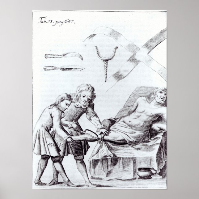 Chirurgische Operation zur Amputation eines Beins Poster (Vorne)