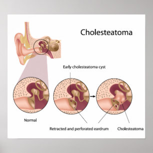 Cholesteatom Mittelohrtumor Poster