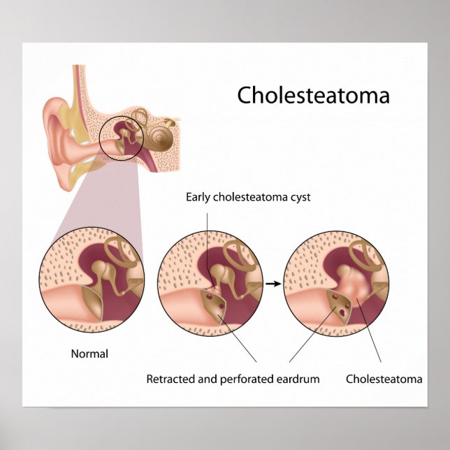 Cholesteatom Mittelohrtumor Poster (Vorne)