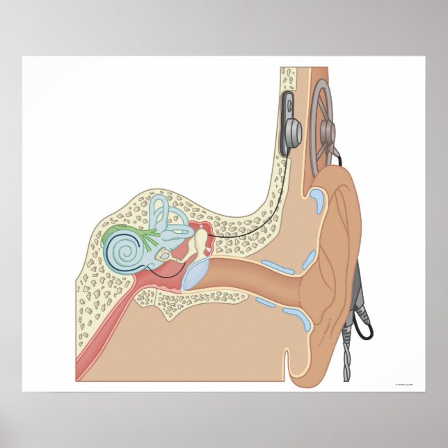 Cochlear Implantate Poster (Vorne)