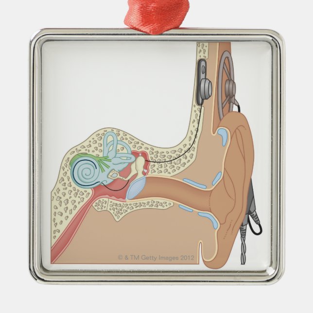 Cochlear- Implantate Silbernes Ornament (Vorne)