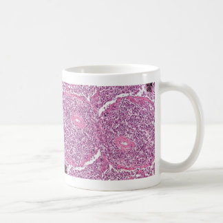 Coffe Tasse-Lunge Krebs-Zellen Tasse
