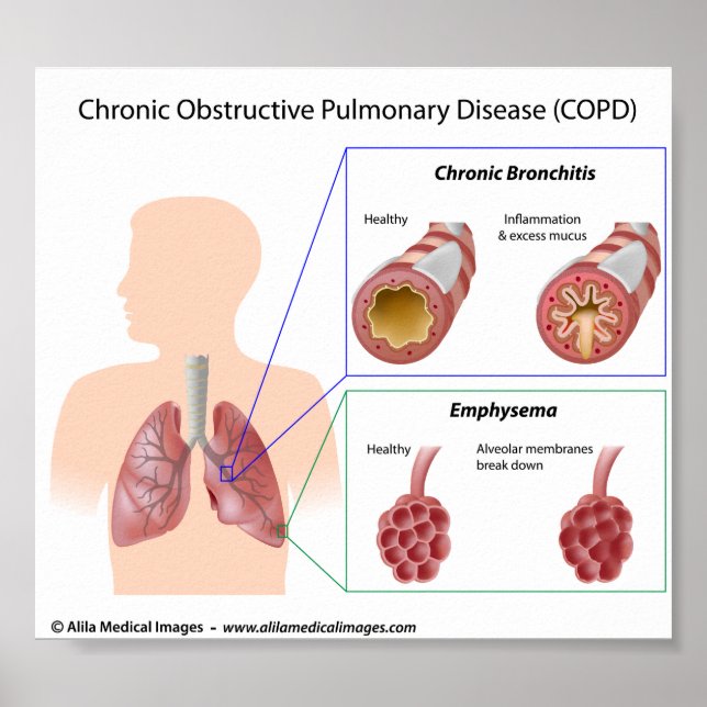 COPD Lung Disease Diagramm Poster (Vorne)