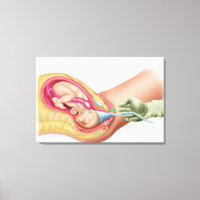 Darstellung der Lieferung von Fetus 1